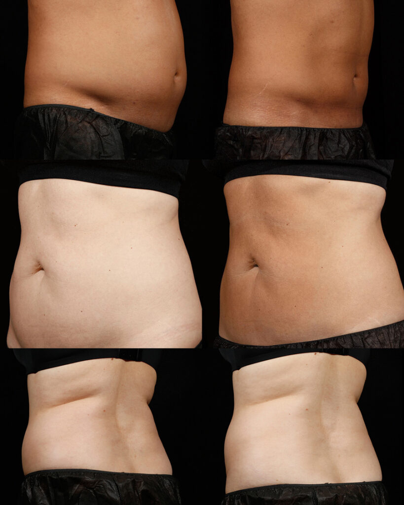 Body Contouring NYC - Minimally Invasive Fat Reduction NYC