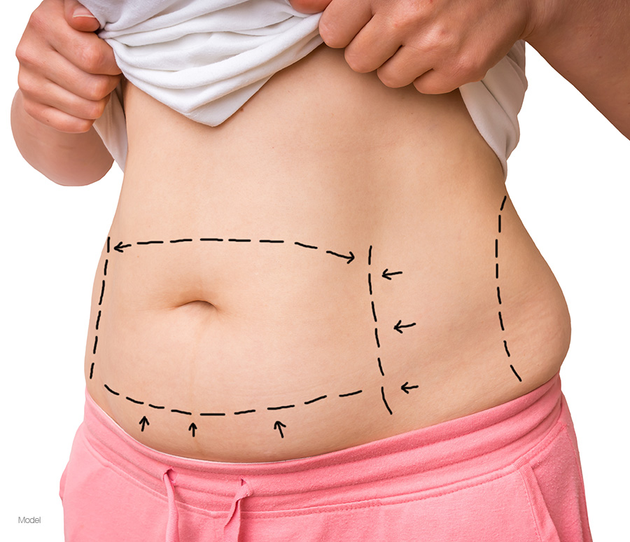 Tummy Tuck NYC - Abdominoplasty Upper East Side NYC