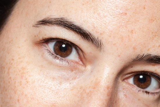 Rosacea & Brown Spots